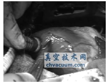 血泵入口引流管的植入:由心尖插入心室腔